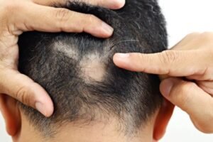 Alopecia Areta Homoeopathic Treatment In Lucknow, India