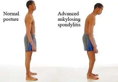 Ankylosing Spondylitis Homoeopathic treatment in Lucknow, India