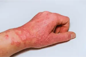 Atopic Dermatitis Homeopathic treatment in Lucknow, India