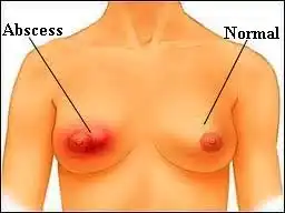 Breast Abscess Homeopathic treatment in Lucknow, India