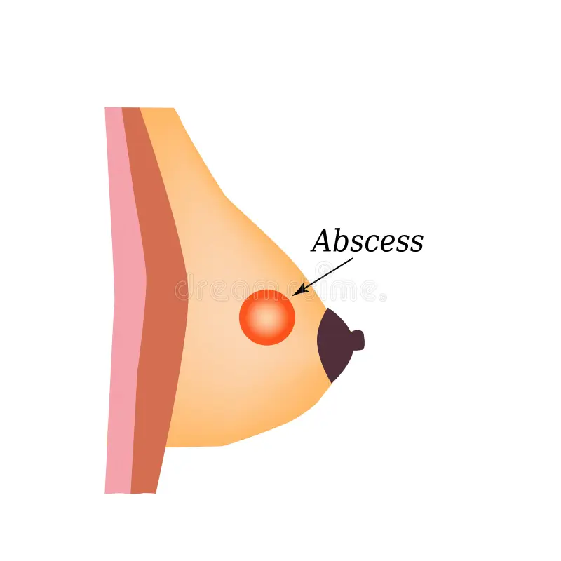 Breast Abscess treatment in Lucknow, India