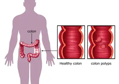 Colon Polyps or Bowel Polyps Homeopathic treatment in Lucknow, India
