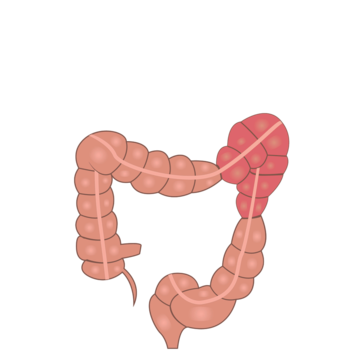 Irritable Bowel Disease