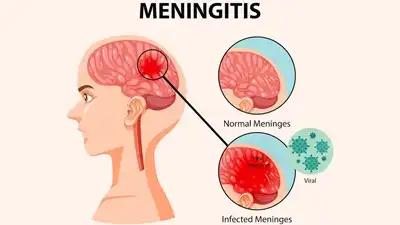 Meningitis Homeopathic treatment in Lucknow, India