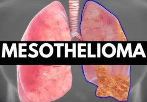 Mesothelioma Homeopathic treatment in Lucknow, India