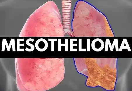Mesothelioma Homeopathic treatment in Lucknow, India