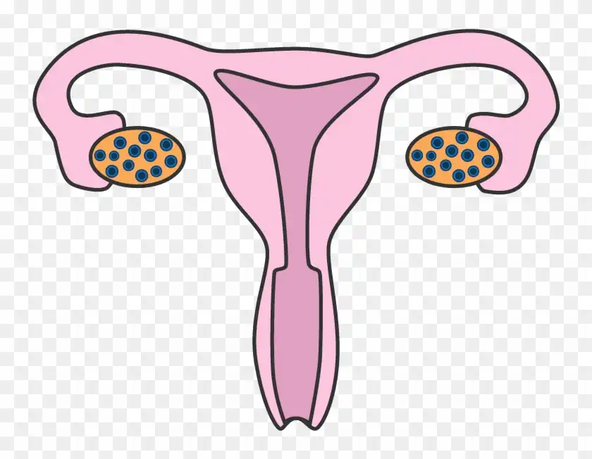 PCOS or PCOD treatment in Lucknow