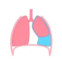 Pleural Effusion treatment in Lucknow, India
