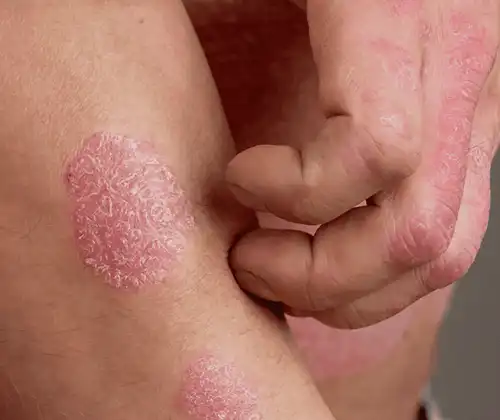 Psoriasis Homoeopathic treatment in Lucknow, India