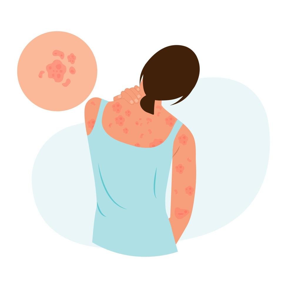Psoriasis