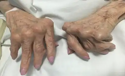 Rheumatoid Arthritis Homeopathic treatment in Lucknow, India