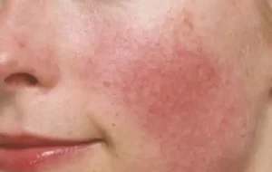 Rosacea Homeopathic Treatment in Lucknow, India