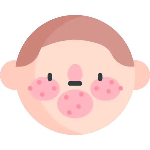 Rosacea