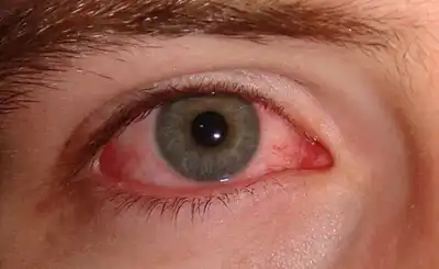 Best Conjunctivitis (Pink Eye) Homeopathic Treatment in Lucknow, India