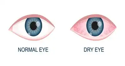 Best Dry Eye Syndrome Homeopathic Treatment in Lucknow, India