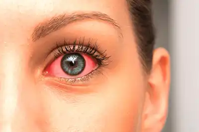 Best Glaucoma Homeopathic Treatment in Lucknow, India