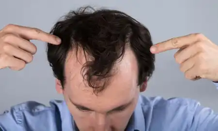 Best Homeopathic Treatment for Hair Fall in Lucknow, India