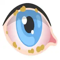 Blepharitis Treatment in Lucknow, India