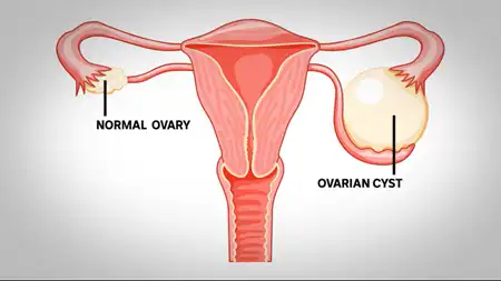 Ovarian Cysts Homeopathic Treatment in Lucknow, India