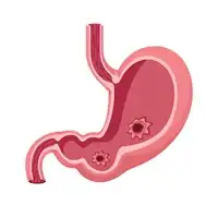 Peptic Ulcer Homeopathic Treatment in Lucknow, India