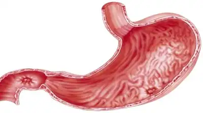 Peptic Ulcer Homeopathic Treatment in Lucknow, India