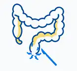 Anal Fissure Treatment in Lucknow, India