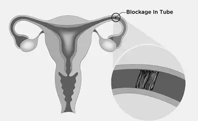 Best Fallopian Tube Blockage Homeopathic Treatment in Lucknow, India