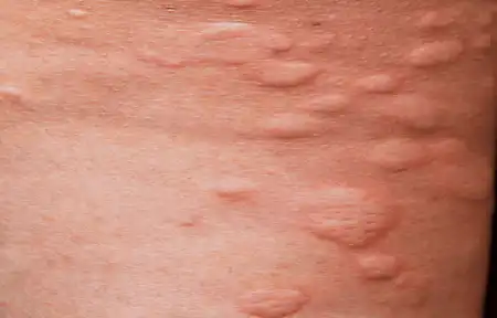 Best Hives (Urticaria) Homeopathic Treatment in Lucknow, India