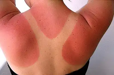 Best Sunburn Homeopathic Treatment in Lucknow, India