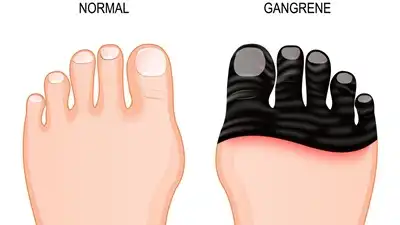 Gangrene Homeopathic Treatment in Lucknow