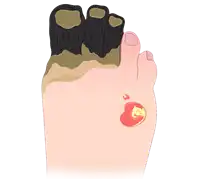 Gangrene Treatment in Lucknow