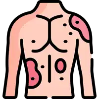 Hives (Urticaria) Treatment in Lucknow, India