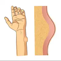 Lipoma treatment in Lucknow India