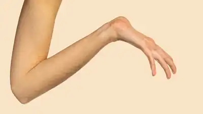 Marfan Syndrome Homeopathic Treatment in Lucknow