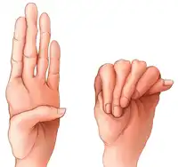 Marfan Syndrome treatment in Lucknow