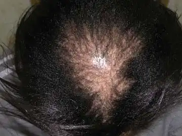 Scarring or Cicatricial Alopecia Homeopathic Treatment in Lucknow India