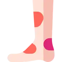 Diabetic foot Treatment in Lucknow india