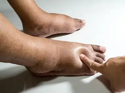Diabetic foot homeopathic treatment in lucknow india