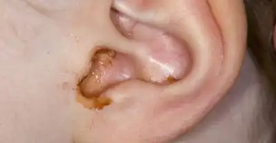 Ear Discharge Homeopathic Treatment in Lucknow, India