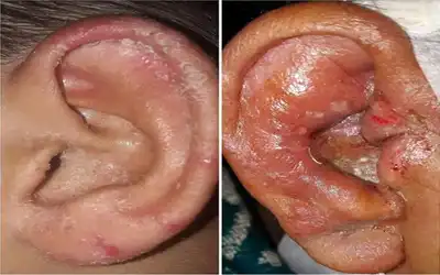 Fungal Ear Infection (Otomycosis) Homeopathic Treatment in Lucknow India