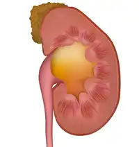 Hydronephrosis Treatment in Lucknow India