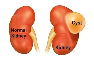 Kidney Cyst Homeopathic Treatment in Lucknow, India