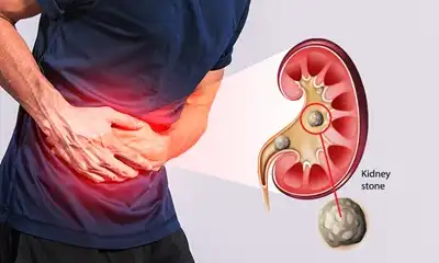 Kidney Stone Homeopathic Treatment in Lucknow, India