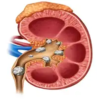 Kidney Stone Treatment in Lucknow India