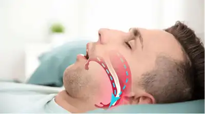 Sleep Apnea Homeopathic Treatment in Lucknow India