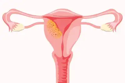 Adenomyosis Homeopathic Treatment in Lucknow India