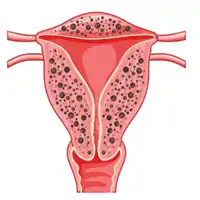 Adenomyosis Treatment in Lucknow India
