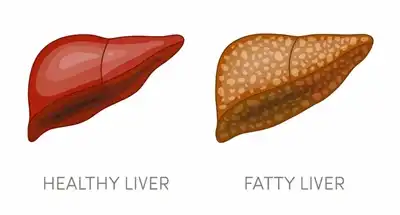 Fatty Liver Homeopathic Treatment in Lucknow India