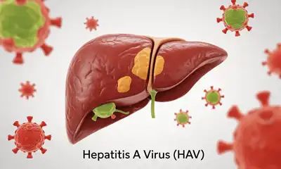 Hepatitis A Homeopathic Treatment in Lucknow