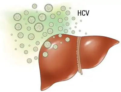 Hepatitis C Homeopathic treatment in Lucknow India